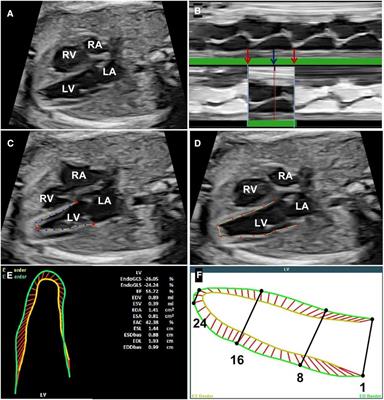 Characteristics and outcomes of fetal ventricular aneurysm and diverticulum: combining the use of a new technique, fetal HQ